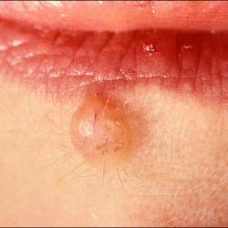 Example of moleRemoval